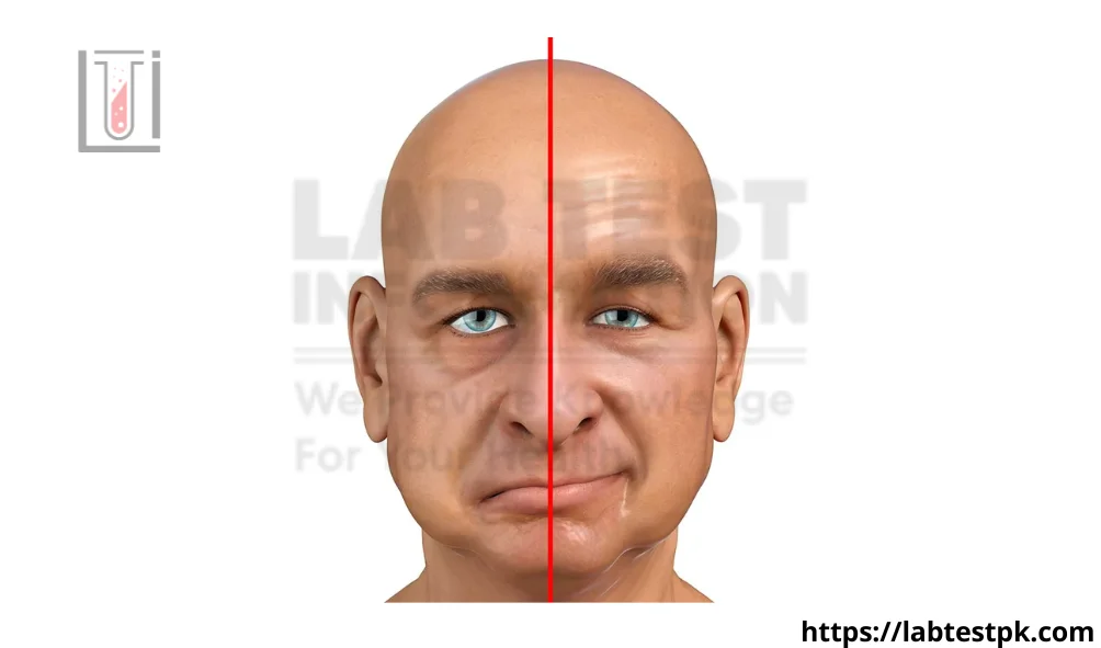 How To Manage Bell's Palsy Bradycardia: A Practical Guide