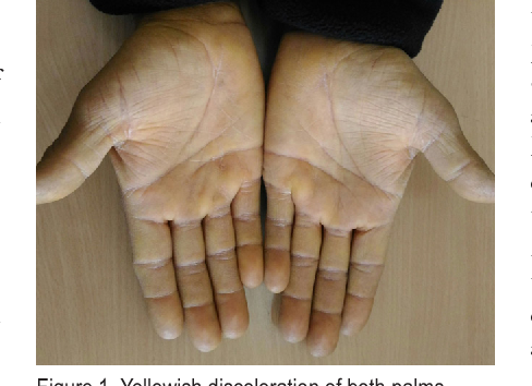 Image Diagnosis Yellow Palms And Soles Look Beyond The Eyes And Think Beyond Hyperbilirubinemia The Permanente Journal