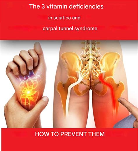 The 3 Vitamin Deficiencies In Sciatica And Carpal Tunnel Syndrome