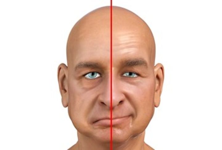 Understanding Bell Amp 39 S Palsy Symptoms Causes Diagnosis Treatment And