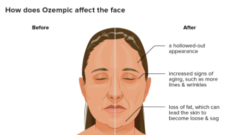 What Is Ozempic Face And How To Prevent It