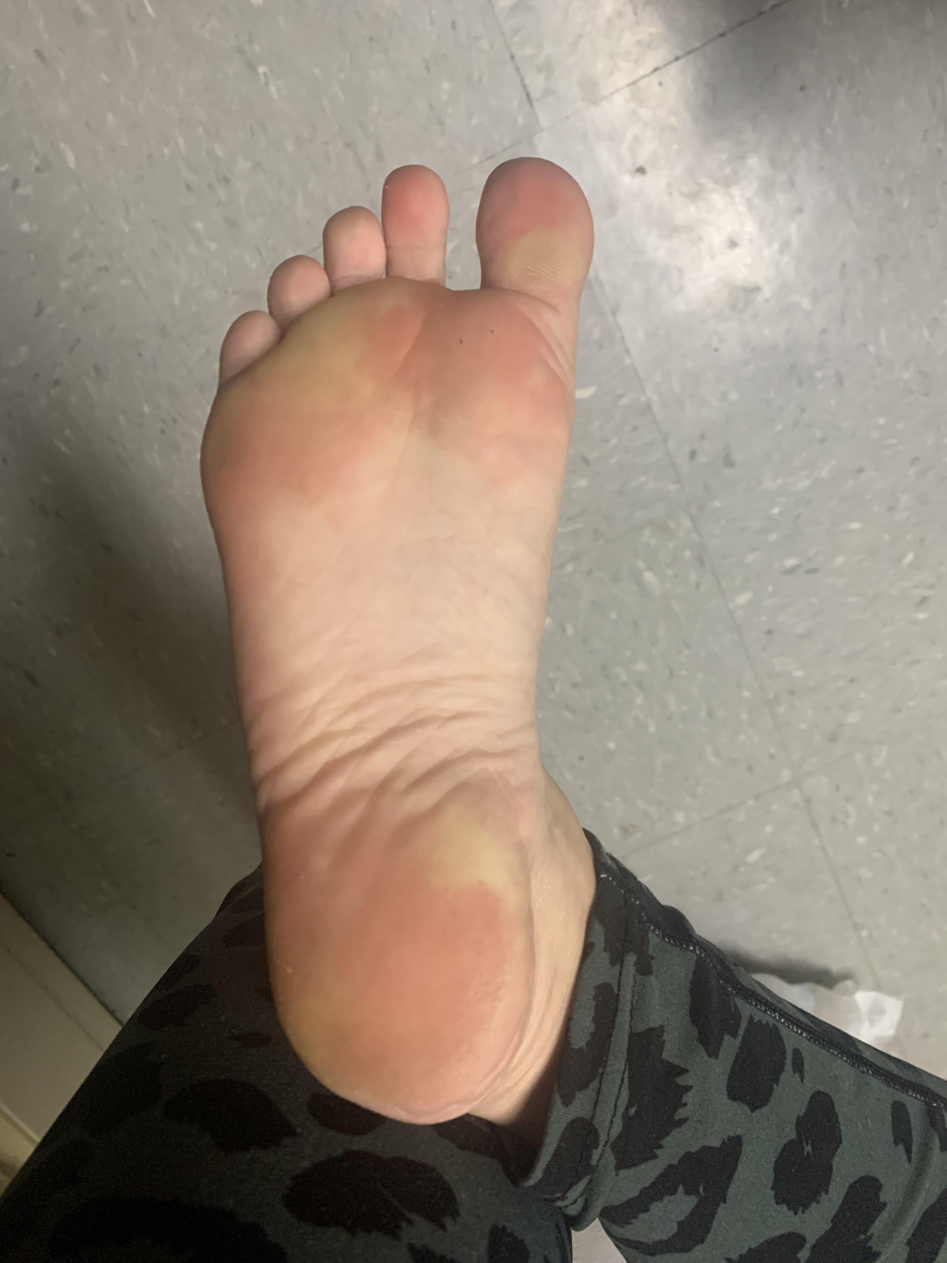 Yellow Feet 6 Potential Causes